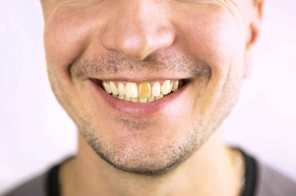 Comment une clinique dentaire traite-t-elle les dents ébréchées ?